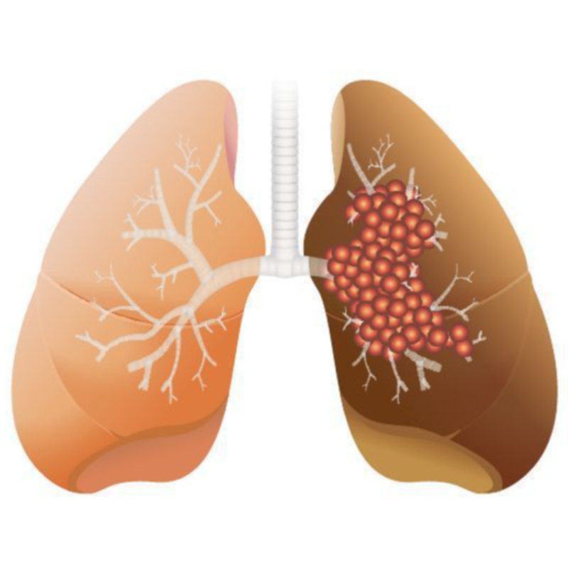 Alta dose de NMN inibe o crescimento do adenocarcinoma pulmonar